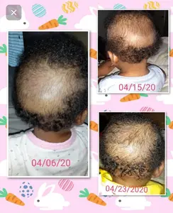 How to grow baby bald spot remedy for the back & top of your baby’s head. When baby hair does grow back after falling out fast hair growth stages are very...