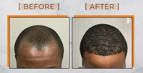 Black Men Hair Transplant [Afro-Textured Hair Loss Replacement]