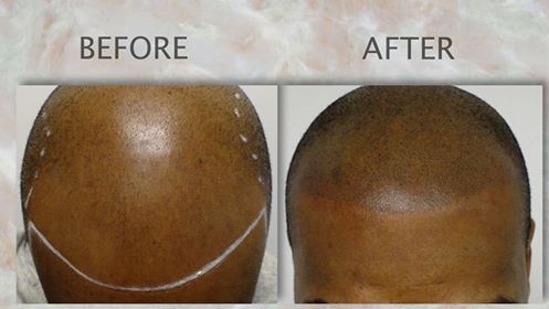 Black men hair transplant