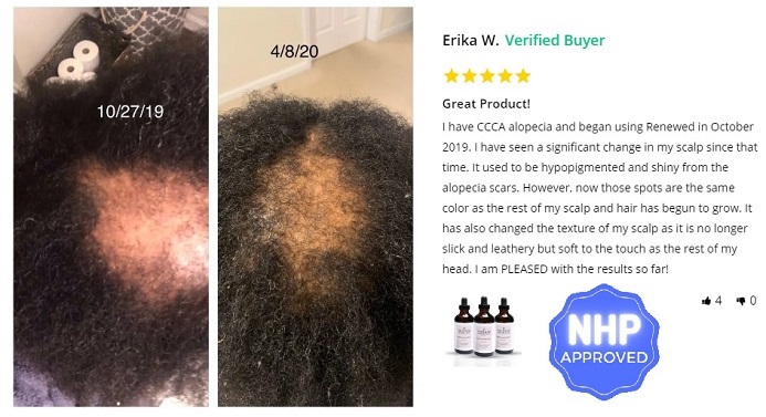 Can Hair Loss Due to Hormonal Imbalance Be Reversed? [ANSWERED]