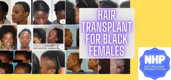 Hair transplant for Black females