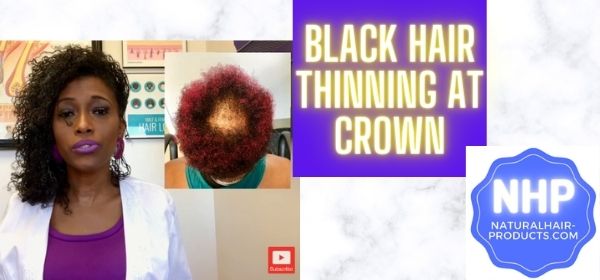 Black hair thinning at crown nhp