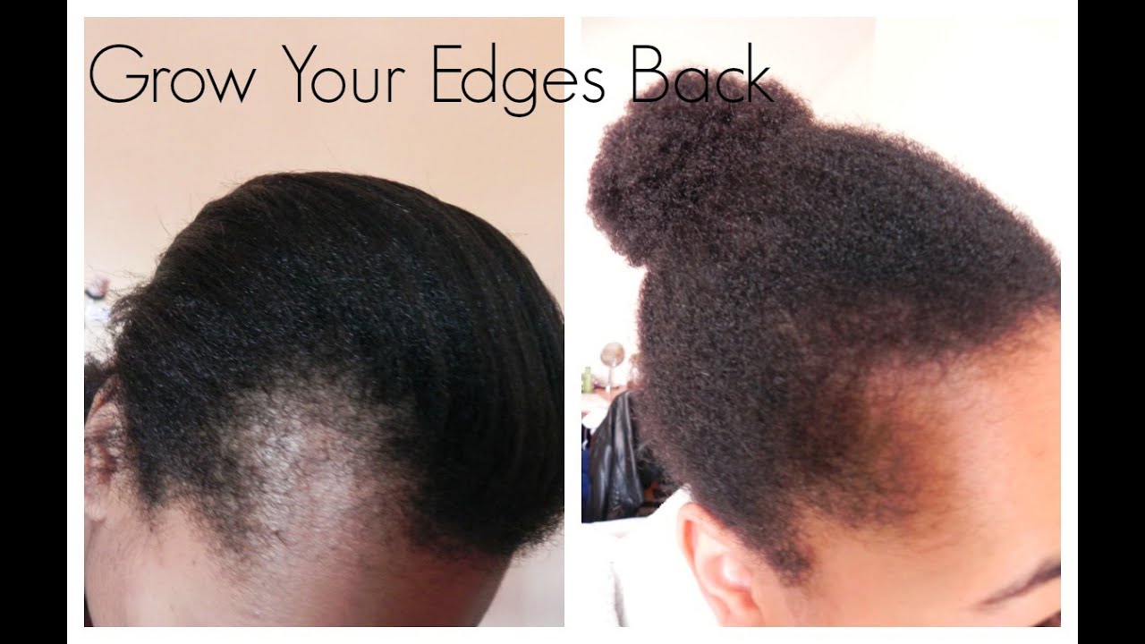 How to regrow hairline. hair growth tutorial regrow edges - how to regrow hair in your frontal hairline naturally