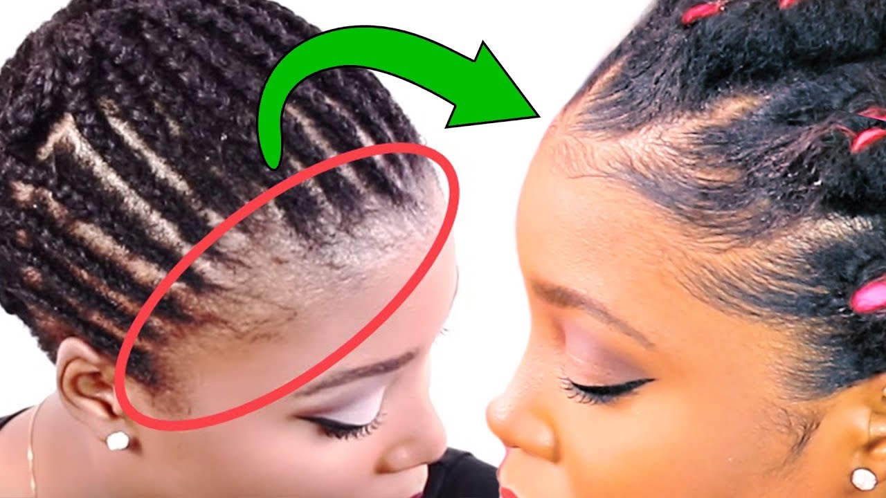How to regrow hairline loss faster.. If your edges STRUGGLE with biotin recipes, you'll know how to regrow your hairline with these 3 unique...