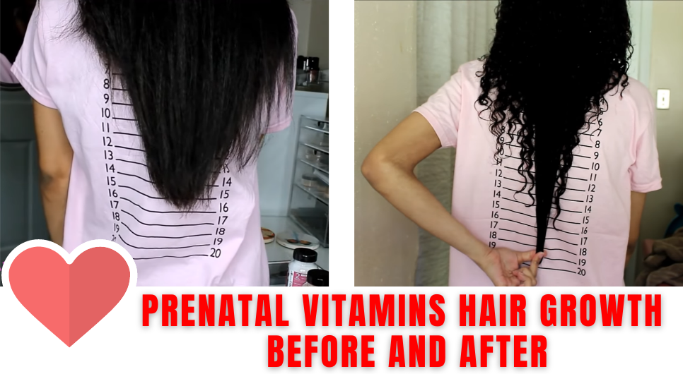 Prenatal Vitamins for Hair Growth Before and After Pictures 
- 3 inches growth in 1 month Results