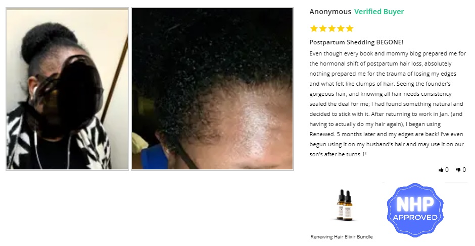 Postpartum Before & After Pics - can hair loss due to hormonal imbalance be reversed.