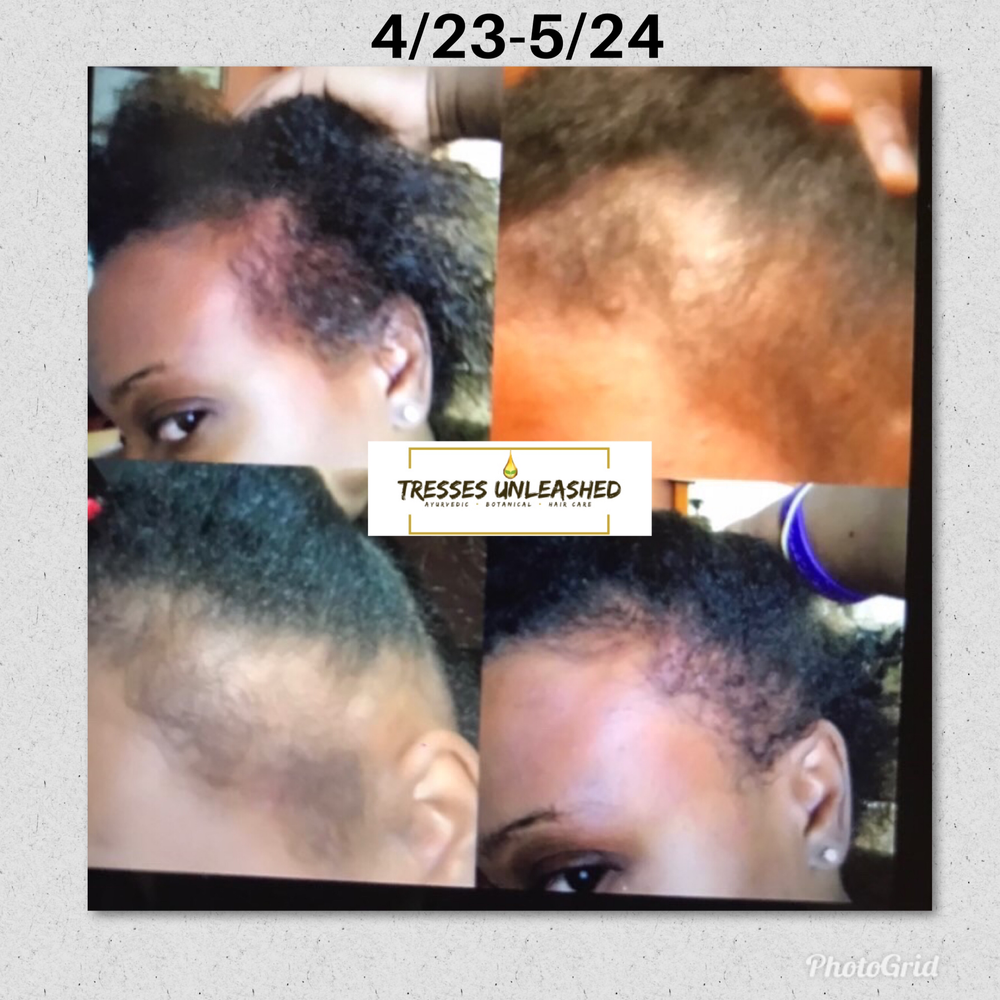 Rosemary Oil And Castor Oil For Hair Growth Before & After Review Picture #2