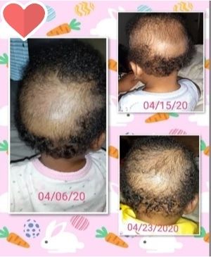 Hair Products For Toddlers With Dry Hair bald spots
