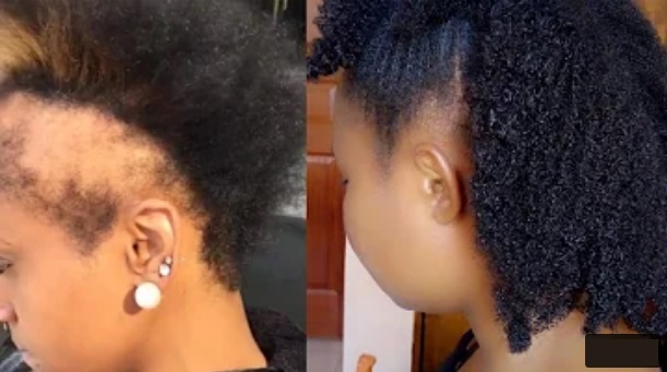 How To Grow My Edges Back From Traction Alopecia