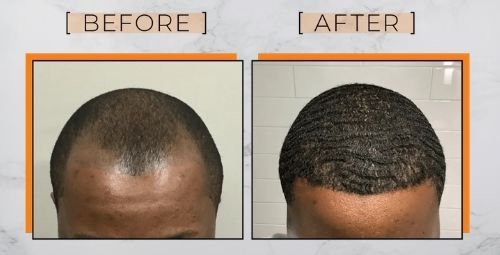 Black men hair transplant before and after. FUE procedure 360 waves