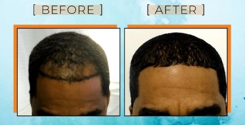 black men hair transplant fue before after