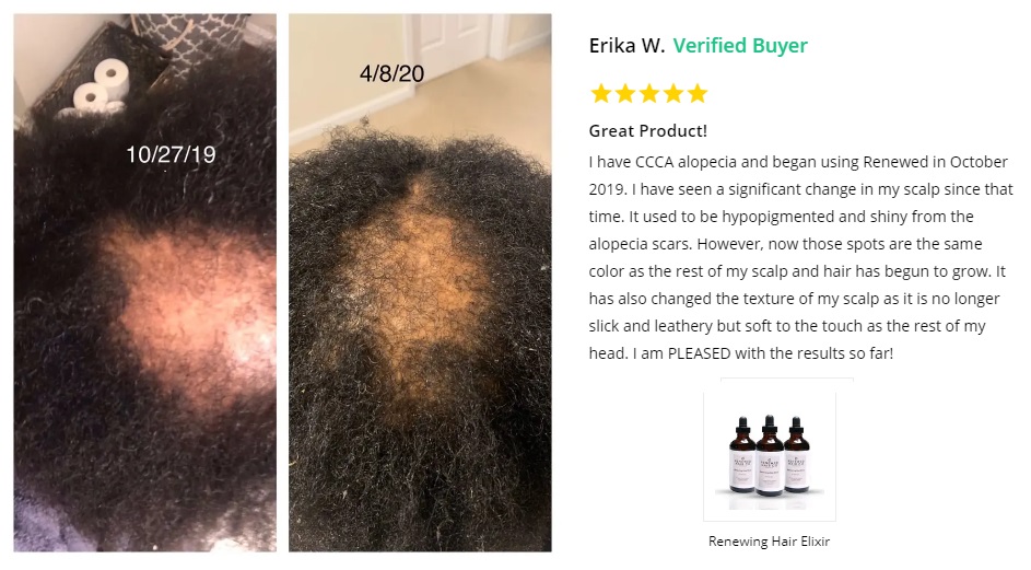 How To Grow My Edges Back From Traction Alopecia AND The Crown...