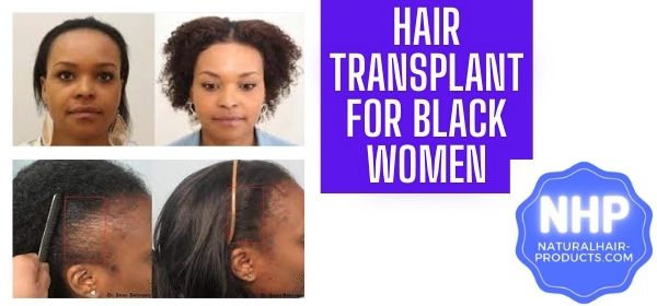 hair transplant for black females Afircan women