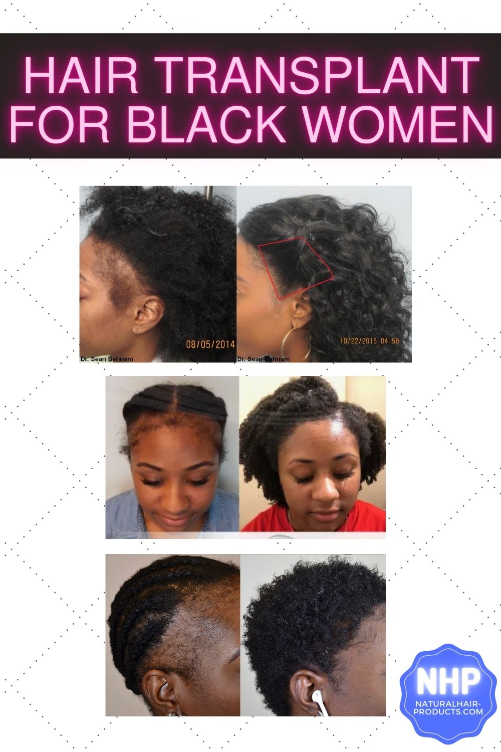 hair transplants for black females before and after photos