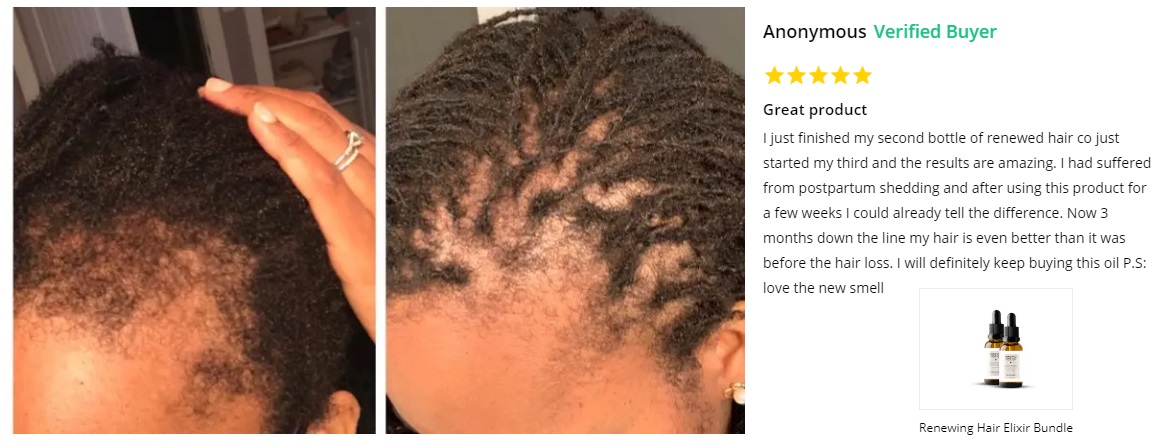How To Grow My Edges Back From Traction Alopecia